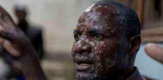 非洲疾控中心宣布mpox为公共卫生紧急情况 news-13082024-185311