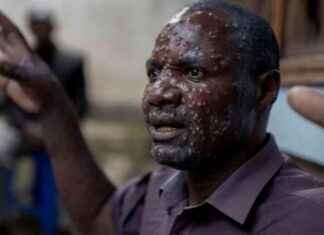 非洲疾控中心宣布mpox为公共卫生紧急情况 news-13082024-185311