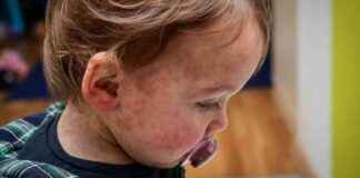 麻疹病毒:感染多年后仍对健康构成危险