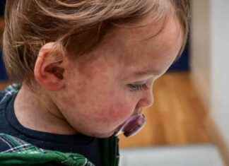 麻疹病毒:感染多年后仍对健康构成危险